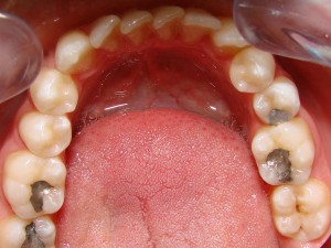 stłoczenie zębów w dolnym łuku zębowym